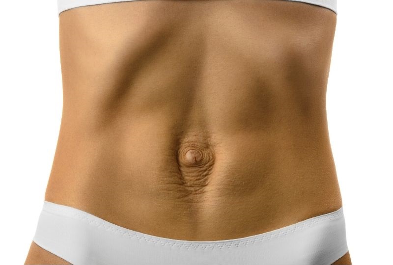 Diastasis Recti tummy gap