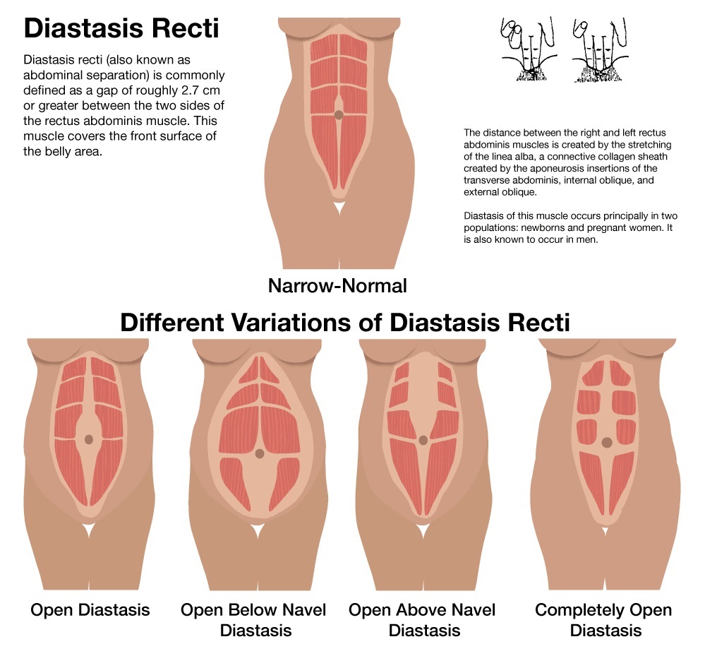 Different variations of Diastasis Recti