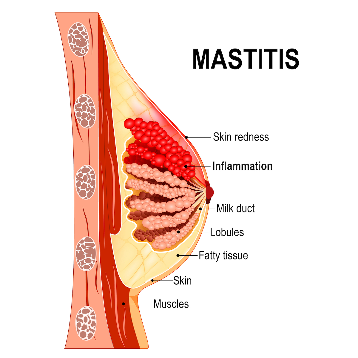 Mastitis