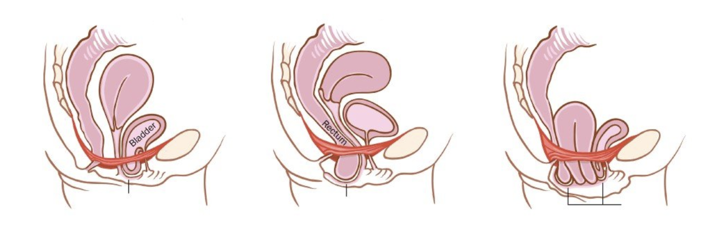 Diagram illustrating three types of pelvic organ prolapse, including bladder prolapse, rectal prolapse and uterine prolapse.