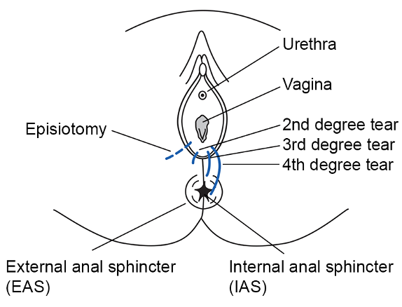 Find out what causes a tear or episiotomy when in labour
