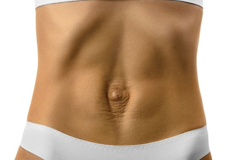 Diastasis Recti Tummy Gap
